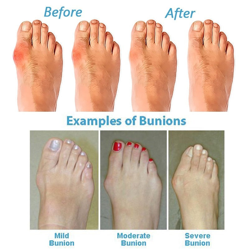 Soulier Orthopédique Correcteur Bunion pour Femme